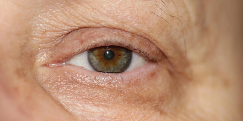 glaucoma